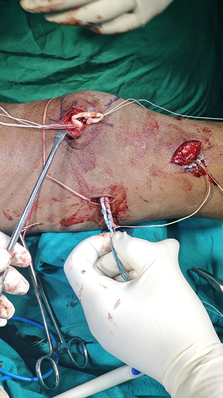 Ligament Reconstruction Surgery