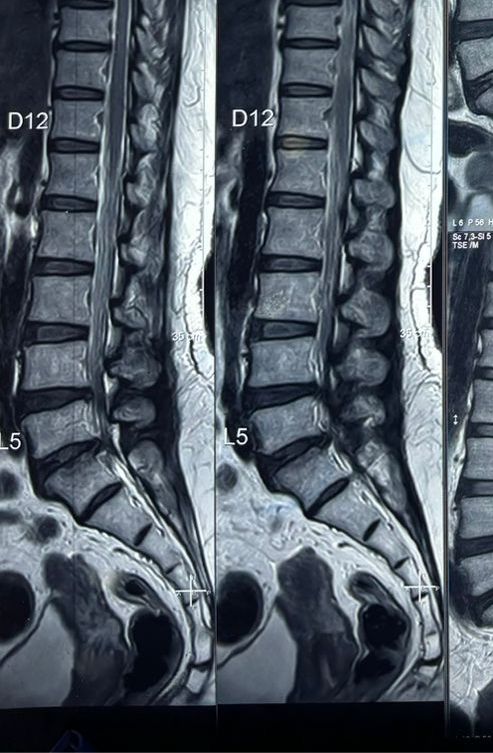 Spine Surgery
