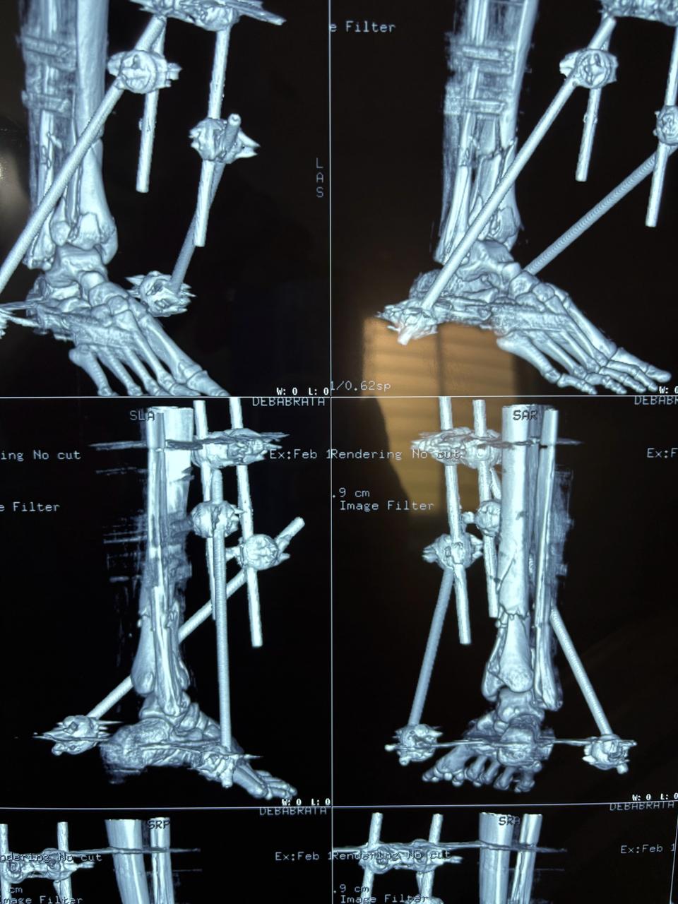 Complex Trauma Surgery